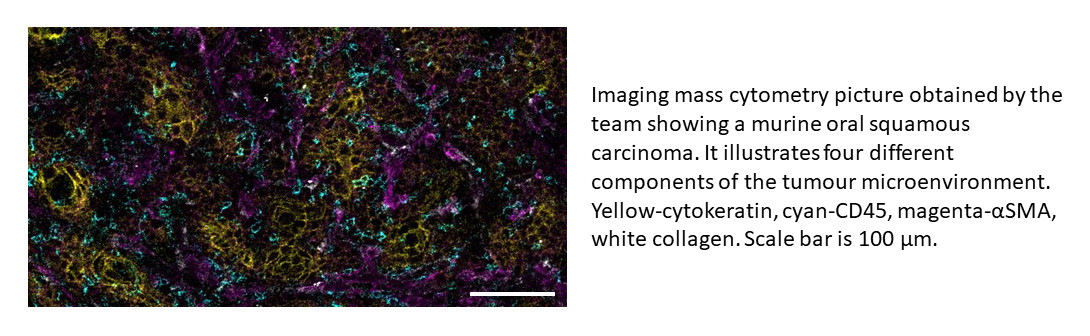 Imaging mass cytometry picture obtained by the team showing a murine oral squamous carcinoma. It illustrates four different components of the tumour microenvironment. Yellow-cytokeratin, cyan-CD45, magenta-αSMA, white collagen. Scale bar is 100 µm.