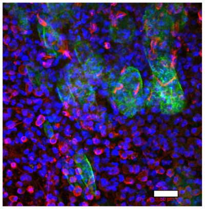 3D TME models (1) Image of colorectal cancer cells (green) and primary fibroblasts (red) at the border between malignant cells and stroma