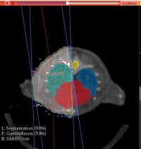 iii) Example CT scan showing tissue definition prior to dose-volume analysis Example CT scan showing tissue definition prior to dose-volume analysis